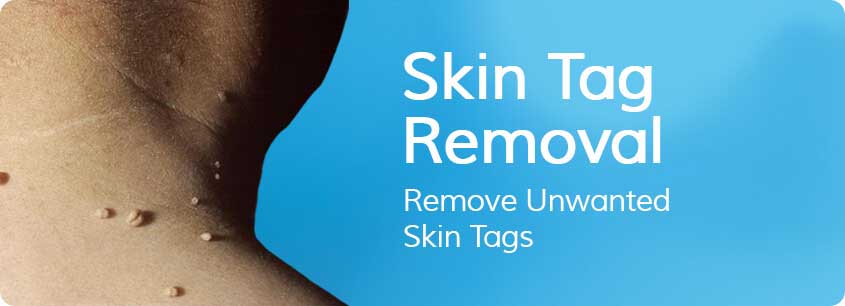 Skin_Tag_Removal